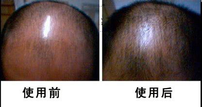 钟馗生发液对脂溢性脱发有用吗