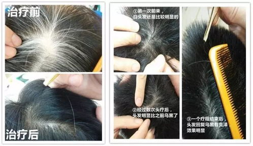 90后 都脱发了 该怎么拯救你的发际线 茶山这家店有招