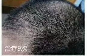 生发案例分享 脂溢性脱发 照这样下去,怕是3年后可以数数了...