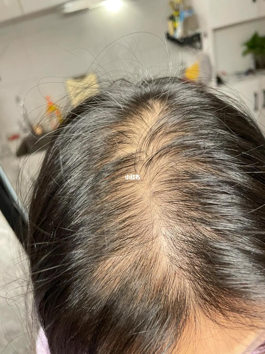 女性脂溢性脱发_脱发_女性脱发_医疗健康_医疗药品