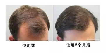 美国博士伦最新研发治疗脱发药物 学瑞米诺地尔凝胶上市