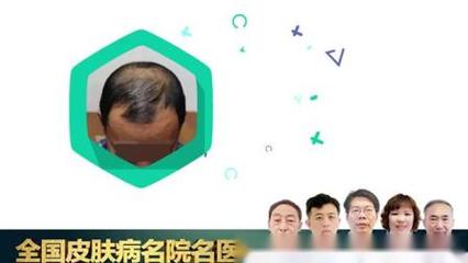门源回族自治县脱发治疗名医【加▲wei信:heidi018获取专属码】哪家医院治疗脱发好 – 搜库