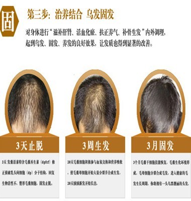 治疗脱发