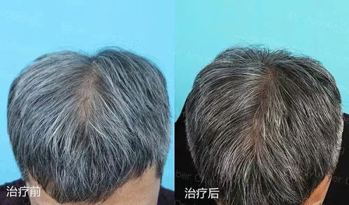 脱发知多少 毛发医生江南一带你了解脱发那些事