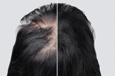 秋季疯狂掉发,哪些方法可以治脱发?