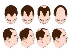 脱发的原因不只一个,找准病因治疗才见效