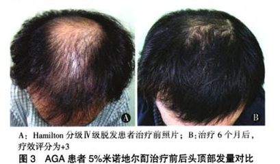 分享治疗脱发:米诺地尔达霏欣和蔓迪的区别