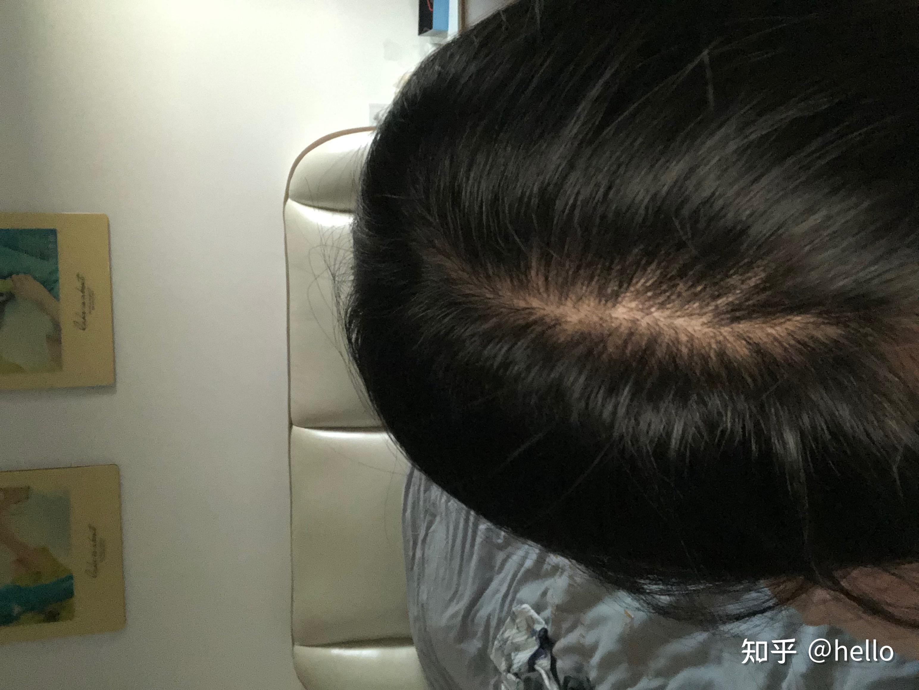 脂溢性脱发治疗
