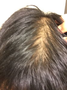 我每天洗头都掉头发,在光线下头可以看见头皮 还有明天掉20多根 关于这个图片是我剥开头发的照片