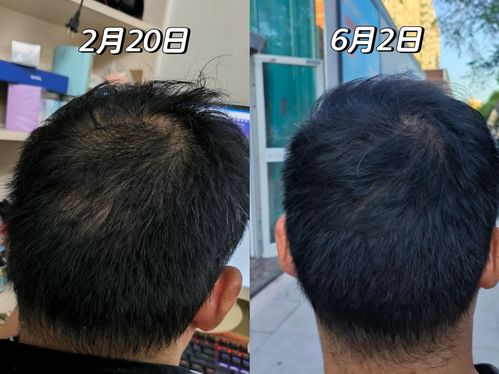 脱发是不是没救了