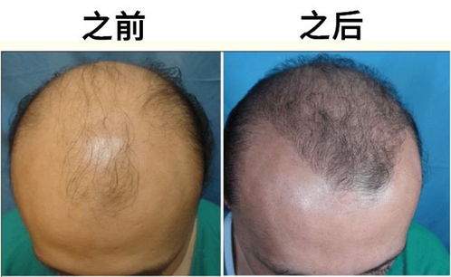 我,25岁,想去植发