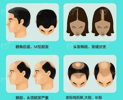 济宁市有植发医院不仅能做毛发移植连脱发也治疗的比较好