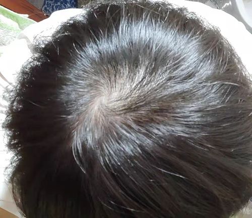 治疗脱发的方法有哪些