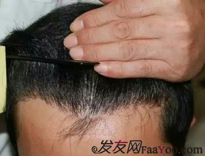 洋美治好了我的脱发 再也不自卑了