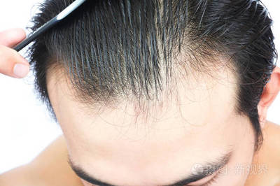 青年男子严重脱发问题医疗保健和洗发水产品概念