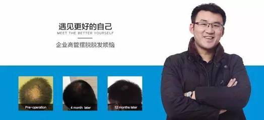 治疗脱发,能从国外学到哪些经验?