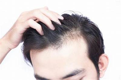 治疗男性型脱发的最佳时间是?