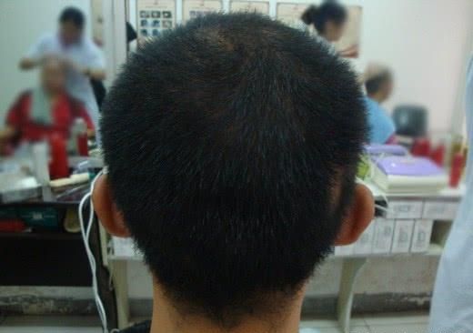 继脱发困扰之后,缺牙成为了当今年轻人的痛