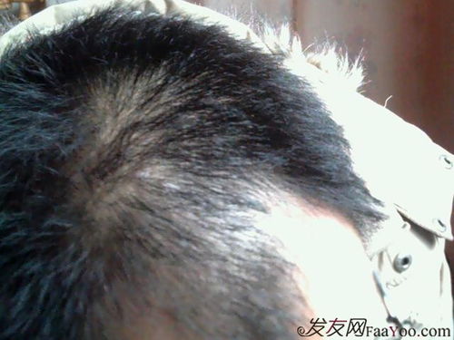 我这个m型脱发还有的治吗 药物治疗