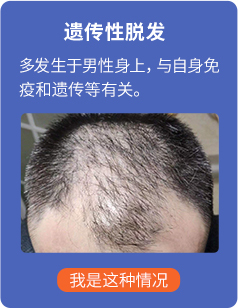 脱发治疗