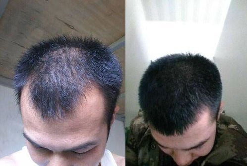 脂溢性脱发吃什么药比较有效