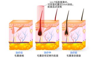 怎样治脱发掉发,黑尔霸激光生发仪通过韩国国立首尔大学临床实验