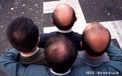 脱发和毛囊有何关系 3d纹发技术解决脱发问题