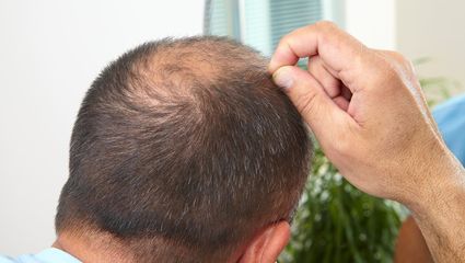 脂溢性脱发应该怎样调理?