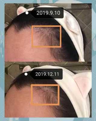 英国脱发怎么办?如何缓解和治疗?