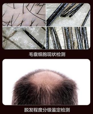 昆明丽都医生讲:偏方治疗脱发不靠谱,还是植发技术效果好!