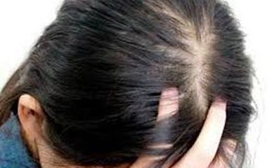 女性脱发原因及治疗