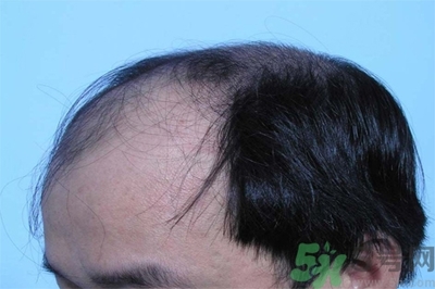 脱发的措施有什么?脱发的注意饮食有哪些?
