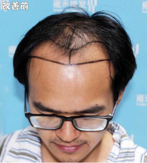 m字脱发怎么办