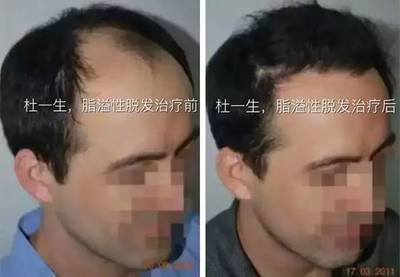 为何斑秃“青睐”年轻人