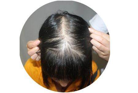 女性脂溢性脱发如根治?脂溢性脱发后怎么生发