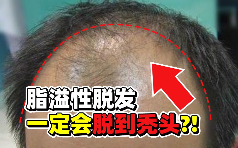 脂溢性脱发不治疗会一直脱下去吗?还有救吗?