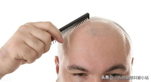 陌生的维生素b7是治疗脱发 皮炎的要药,服用时需注意5点