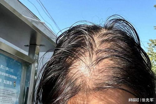 脂溢性脱发问题 药理学硕士分享4步方法,助你养出浓密蓬松秀发