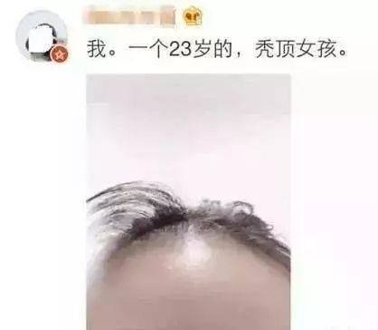 靠这款天然药材洗发水,治好了我的脱发