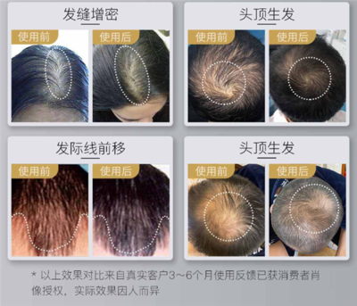 小米有品众筹LLLT激光生发帽:12周长出健康新发