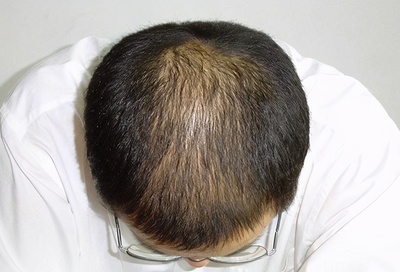 脂溢性脱发怎么生发?方法只有这2个,至于用哪个由你说了算