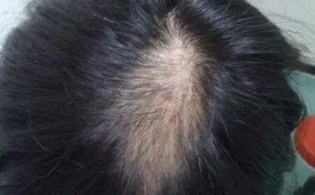 为什么男性更容易比女性脱发