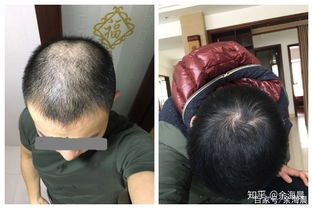 你的头发为什么说没就没了