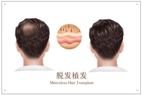 观察 挺 秃 然的,90后带火脱发经济