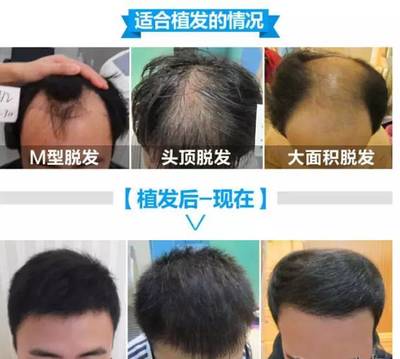 【福利】男性秃顶、女性脱发、掉发严重怎么办?看这里,专家教你解决脱发烦恼!