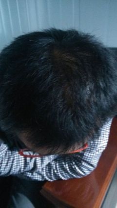 治疗脱发最好的方法,我的生发经历_健康_网