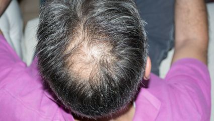 怎么样才能解决脱发?拒绝聪明不绝顶!