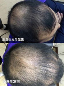 怎么治好我的脱发我脱发有十几年了,这几