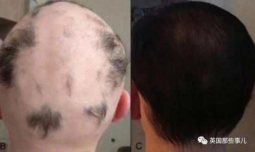 粪便插鼻管疗法治脱发 为了挽救秃头,科学家脑洞是无穷的