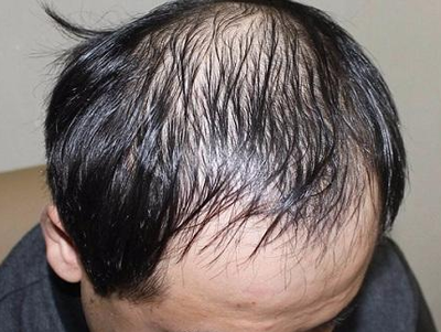 脂溢性脱发吃什么药